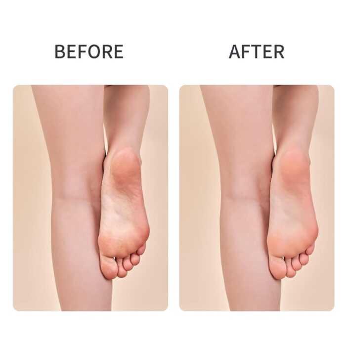 ShowSee Callus Remover B1 - Image 3